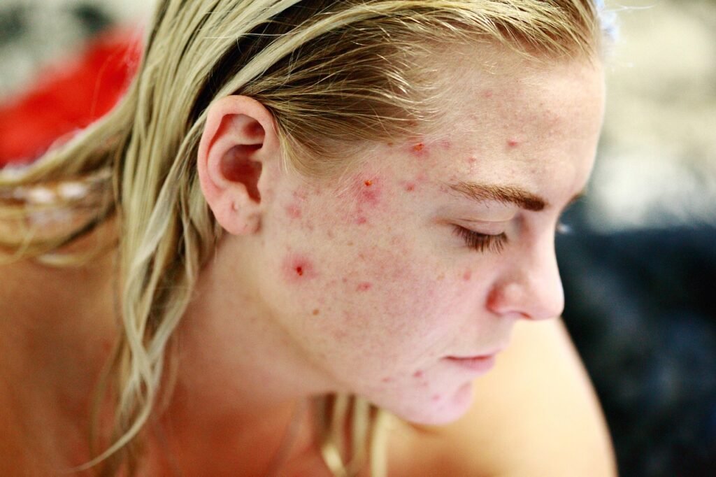 how to get rid of acne